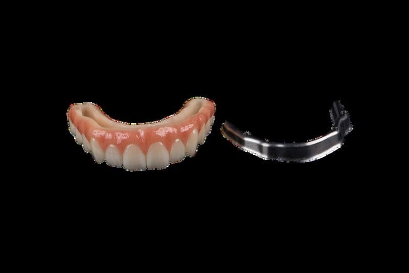 All-on-X PMMA overlay on titanium bar — buccal view
