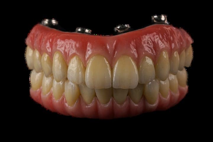 All-on-X zirconia crowns on a thimble bar