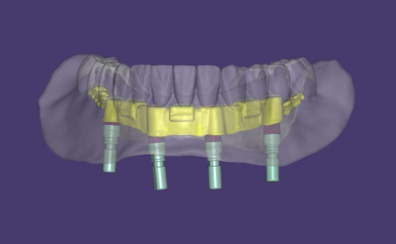 All-on-X zirconia removable full arch on a base