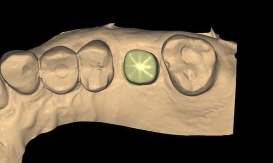 Custom abutment and crown fit on a model