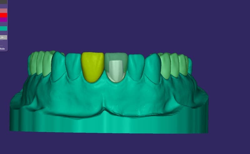 Custom abutment — titanium base with detailed crown margins