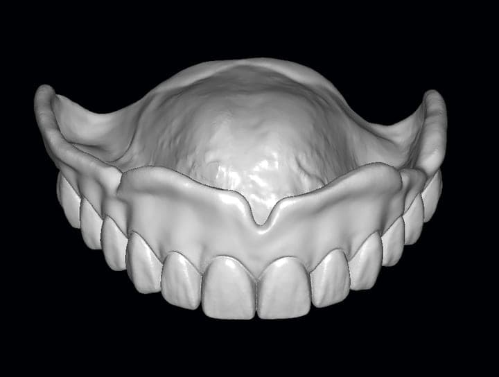 Full denture with gingiva detail on a model