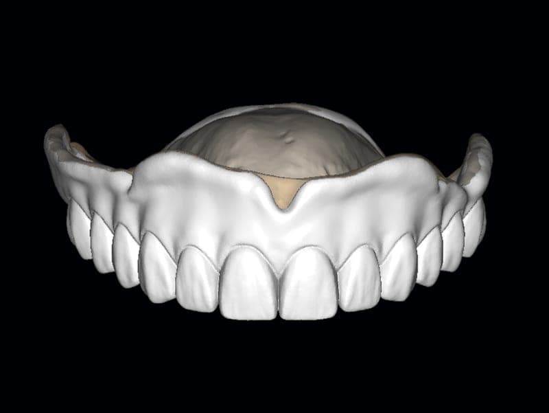 Full denture — pink-base set with upper and lower arches