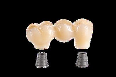 Implant crown and bridge detail on titanium abutments