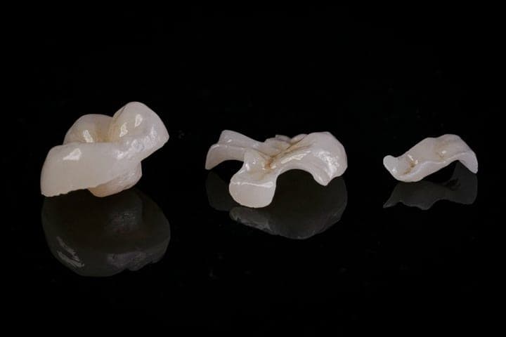 Occlusal detail of inlay/onlay restorations