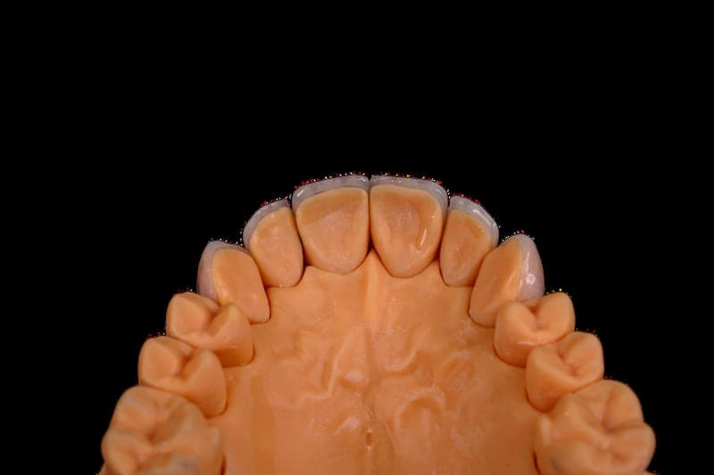 Lithium disilicate crowns seated on a model — buccal view