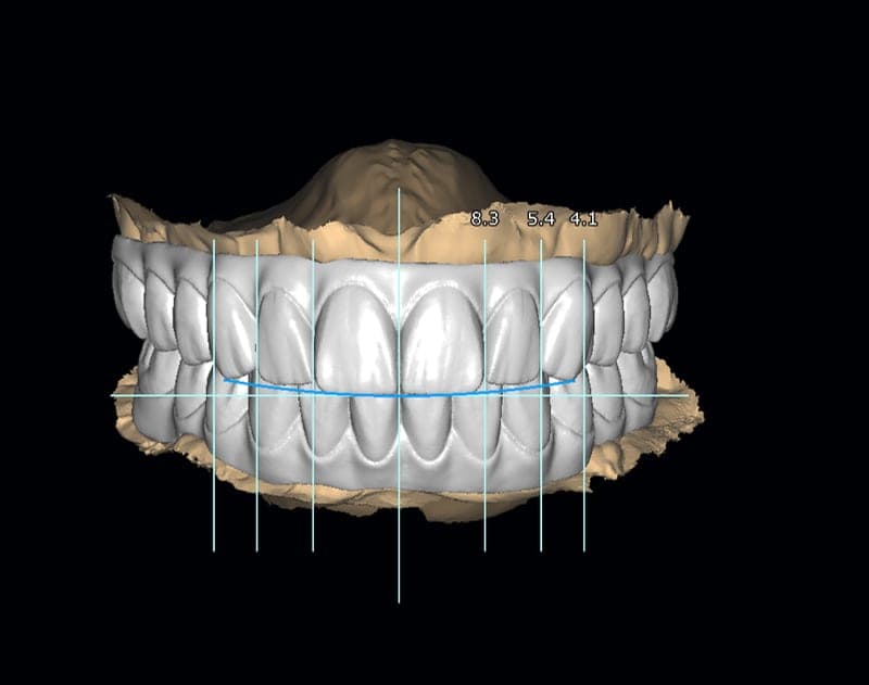 Virtual smile design — digital smile preview on a maxillary model