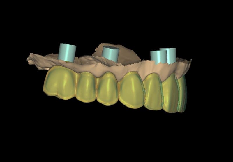 Anatomical screw-retained monolithic restoration for limited space