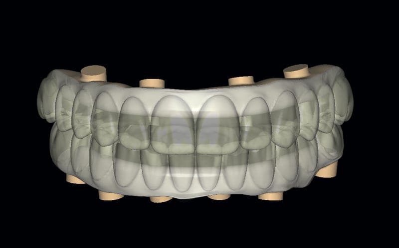 Titanium overlay bar for immediate restoration