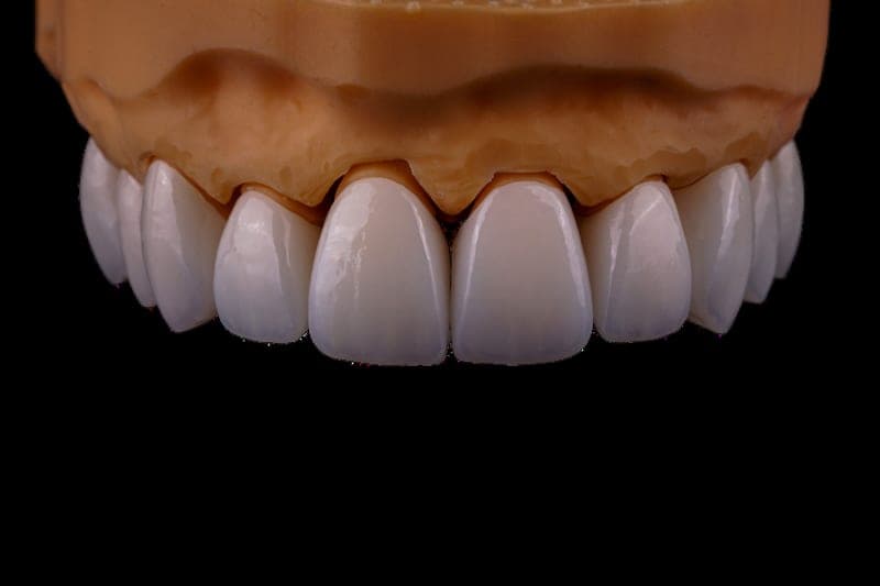 Full-contour zirconia anterior restoration on a model